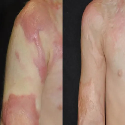 🔥Nuvelliana™: Flatten, Fade, and Improve Your Scars in 14 Days🔥
