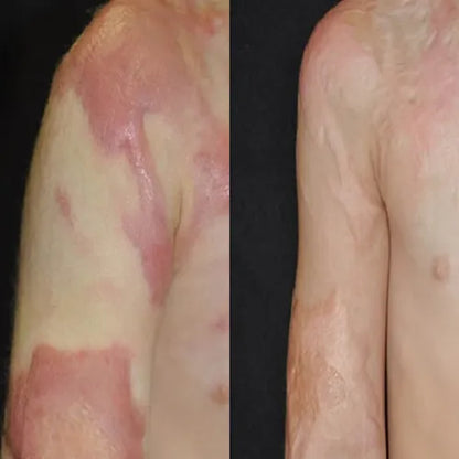 🔥Nuvelliana™: Flatten, Fade, and Improve Your Scars in 14 Days🔥