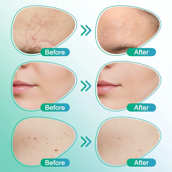 CareBreeze® 3-in-1 Scar Removal Microneedle Care Patch