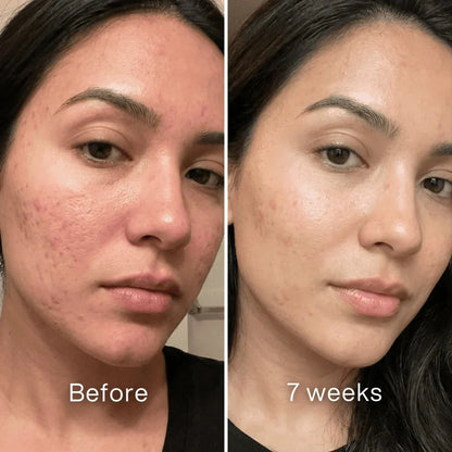 Cheapsu™ Clinical Acne Scar Remodeling Stick